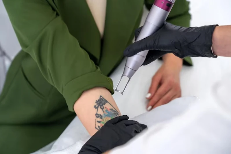 clinica para remoção de tatuagem