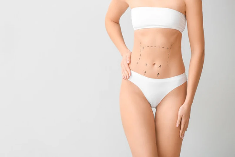 endolifting laser abdominal