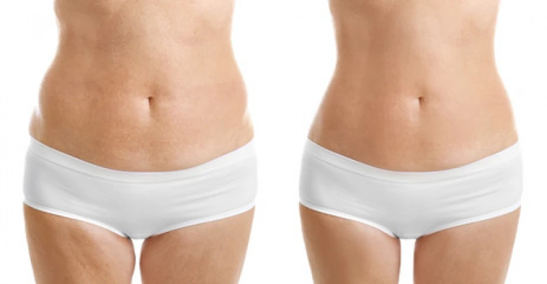endolifting laser