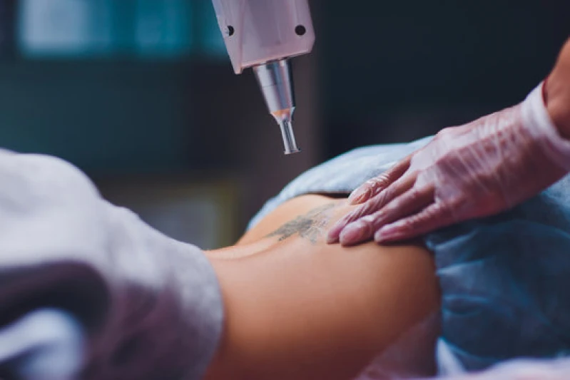 remoção de tatuagem a laser