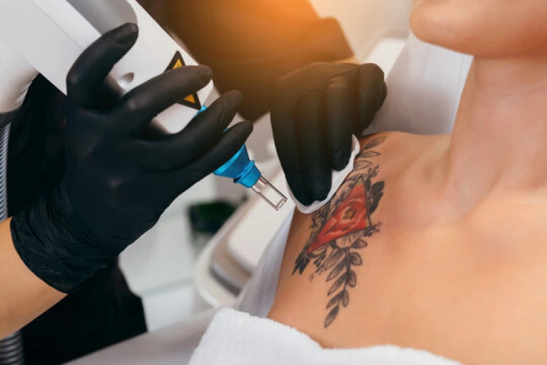 remoção de tatuagem colorida