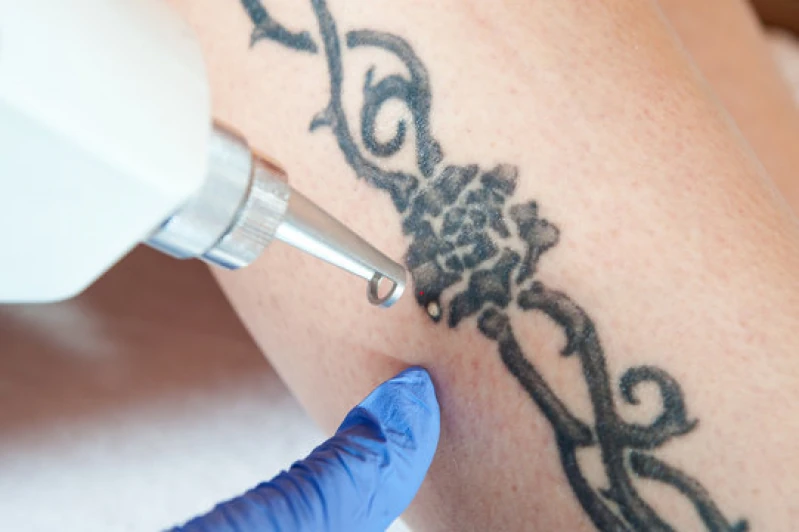 remoção de tatuagem perto de mim