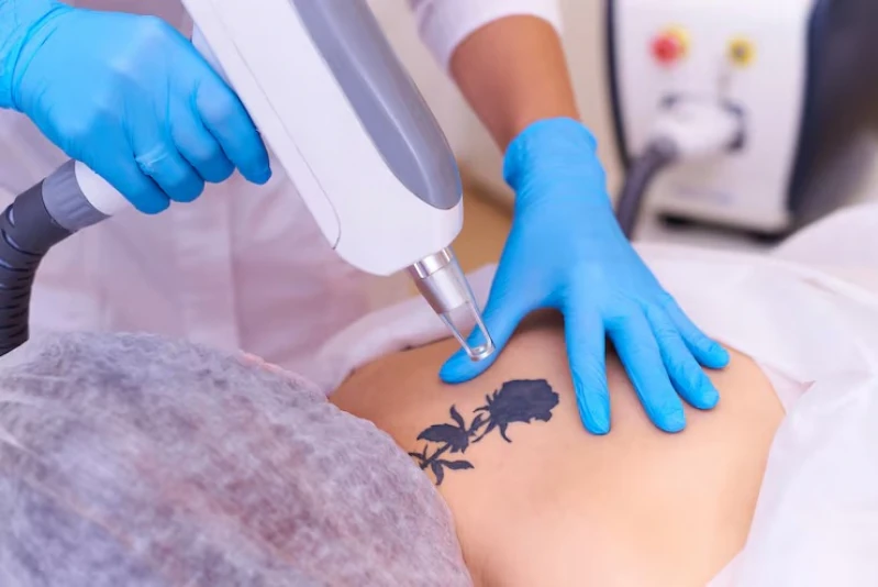 remoção de tatuagem preta