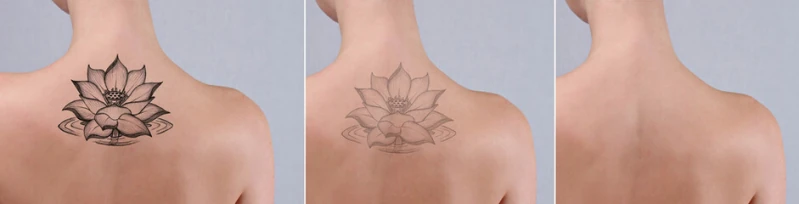 remoção de tatuagens