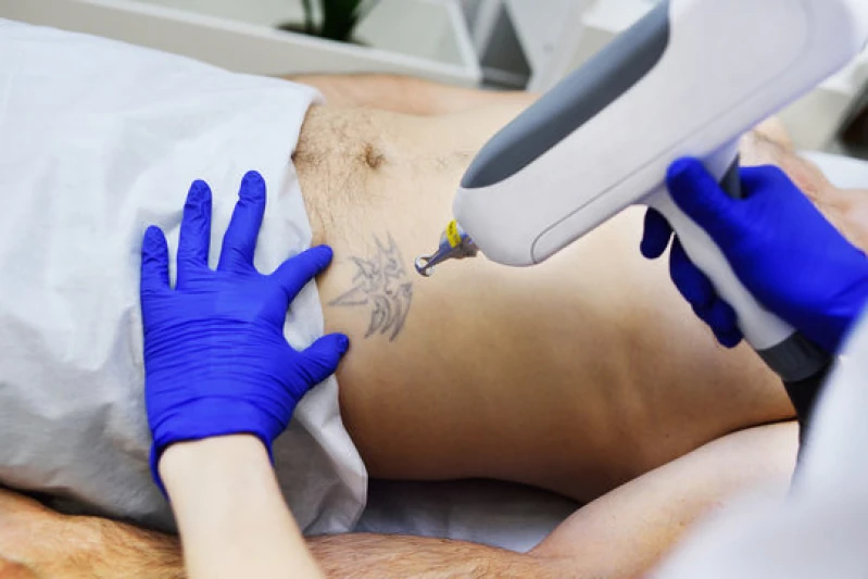 retirada de tatuagem a laser