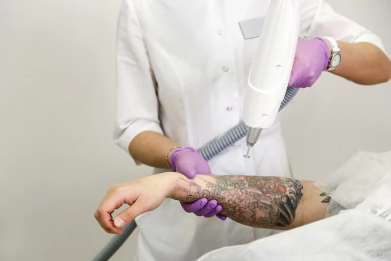 serviço de remoção de tatuagem