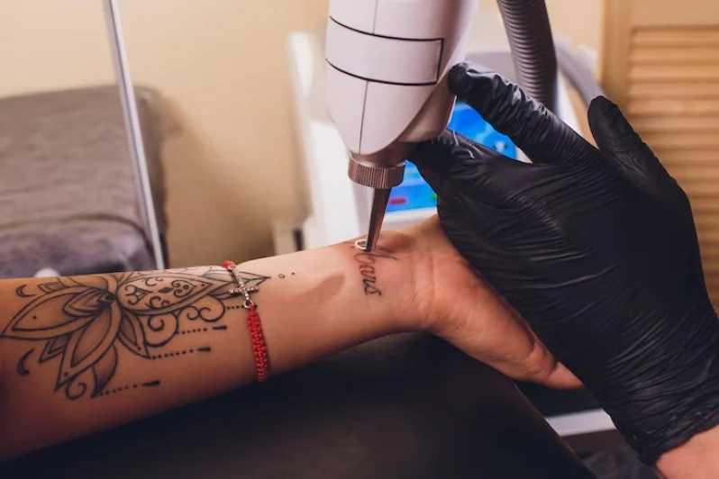 tratamento para apagar tatuagem