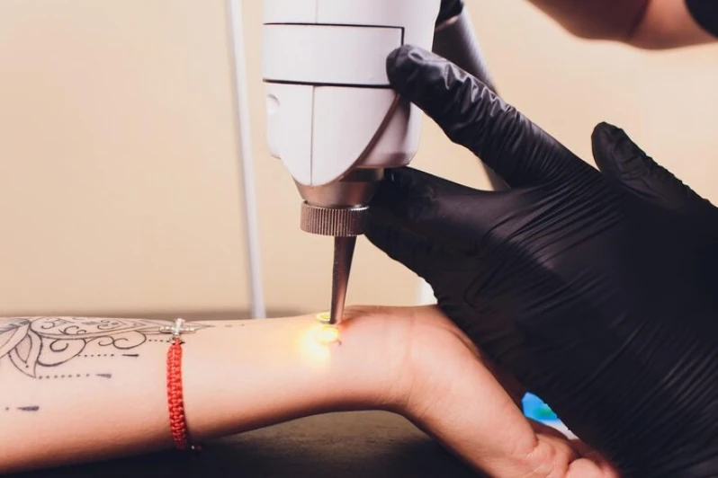 tratamento para tirar tatuagem