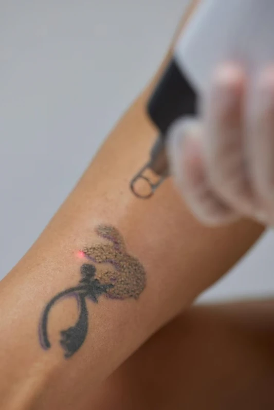 tratamentos para remoção de tatuagens